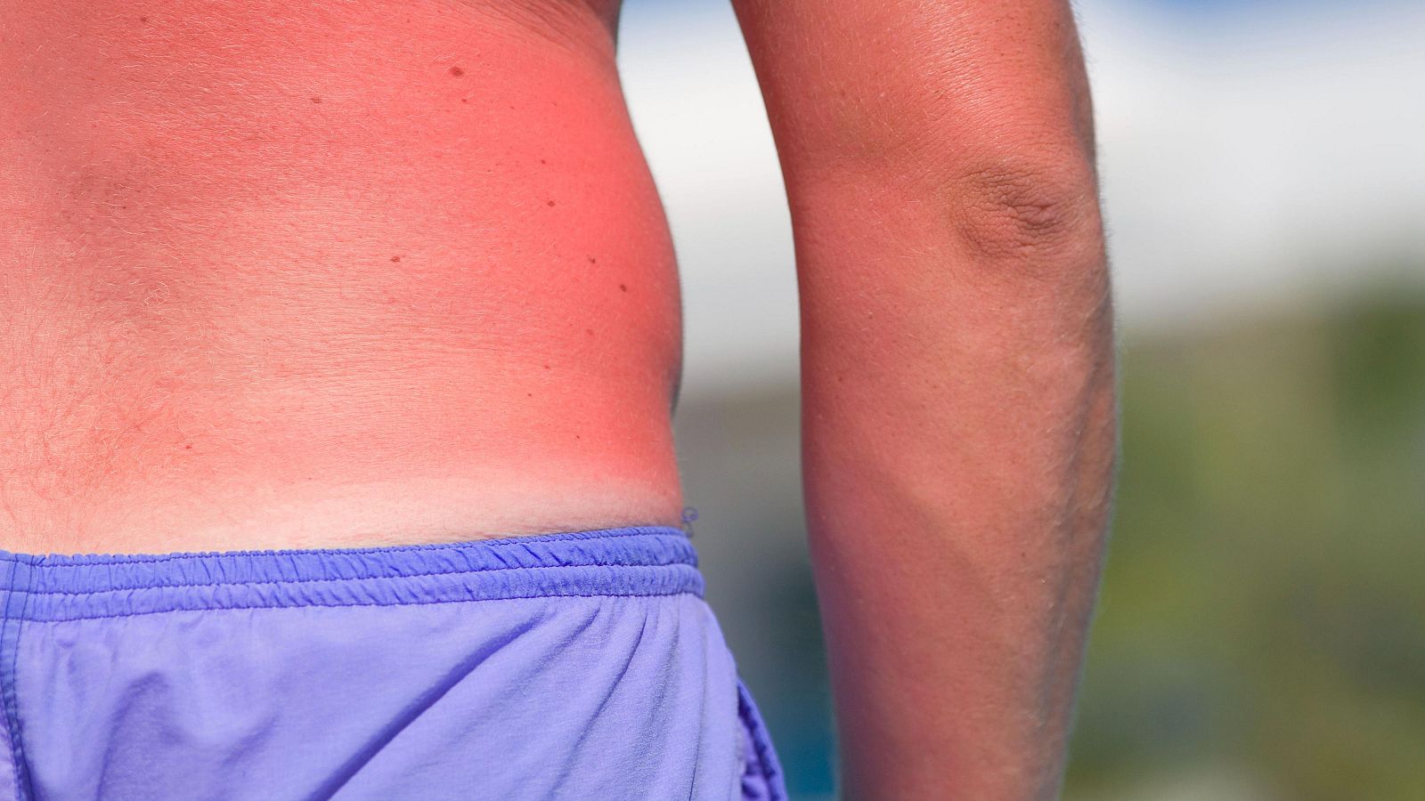 'Callo solar': el bulo que puede ocasionar daños en la piel