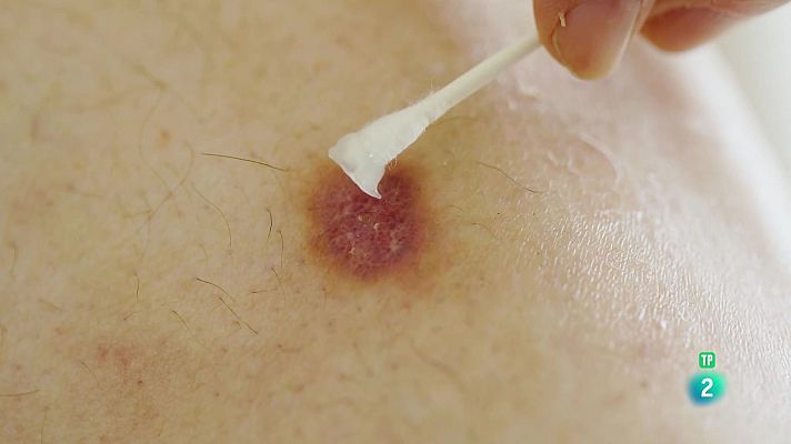 La aventura del Saber - Universo Sostenible: El cáncer de piel