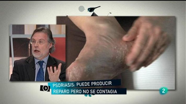 Para todos La 2 - La psoriasis