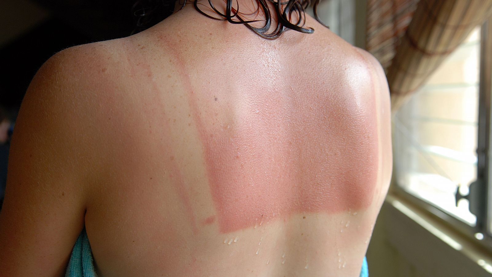 "Callo solar", un mito peligroso de las redes sociales - Telediario 1 | Ver