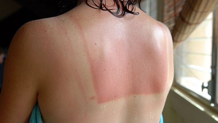 Telediario 1 - "Callo solar", un mito peligroso de las redes sociales que puede ocasionar cáncer