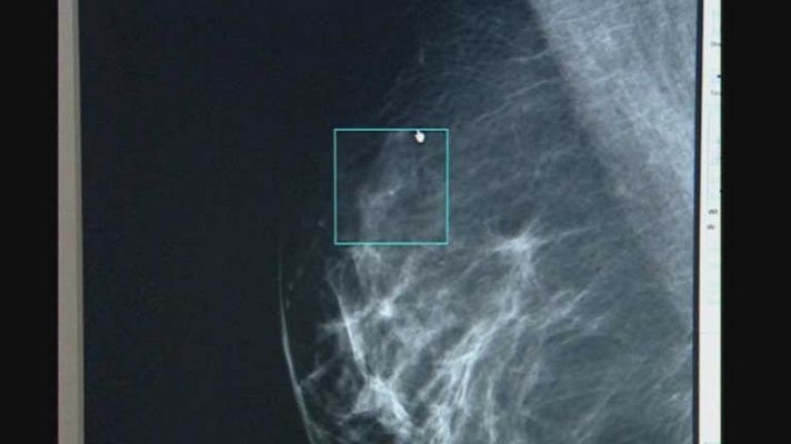 Telediario 1 - Cáncer de Mama