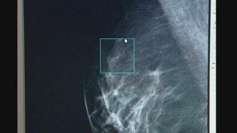 Un grupo de investigadores perfeccionan el diagnóstico de los tumores de mama