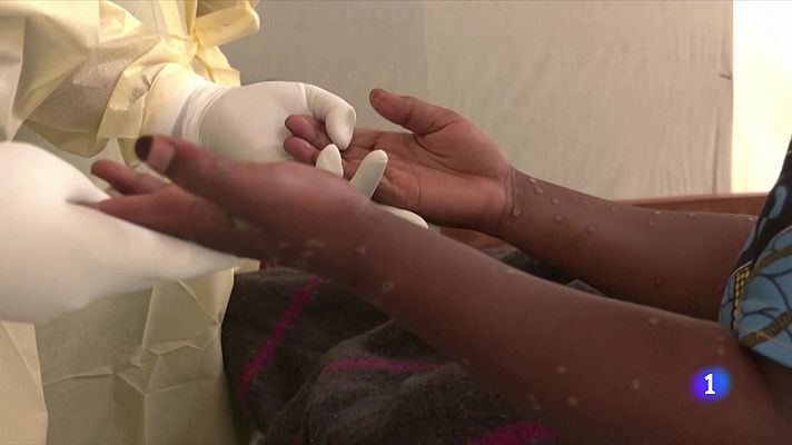 L'Informatiu - La Unió Europea considera baix el risc d'expansió de la verola del mico