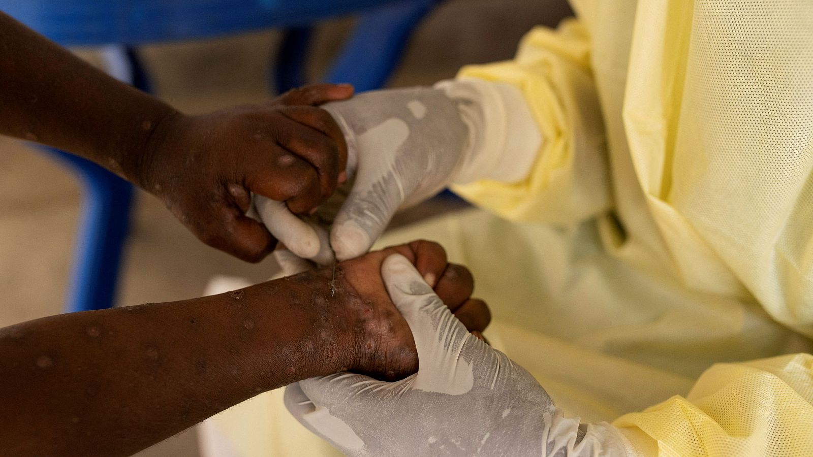 Bulos mpox: no se disparan los casos en España y la OMS no ordena el confinamiento - Informativo 24h | Ver