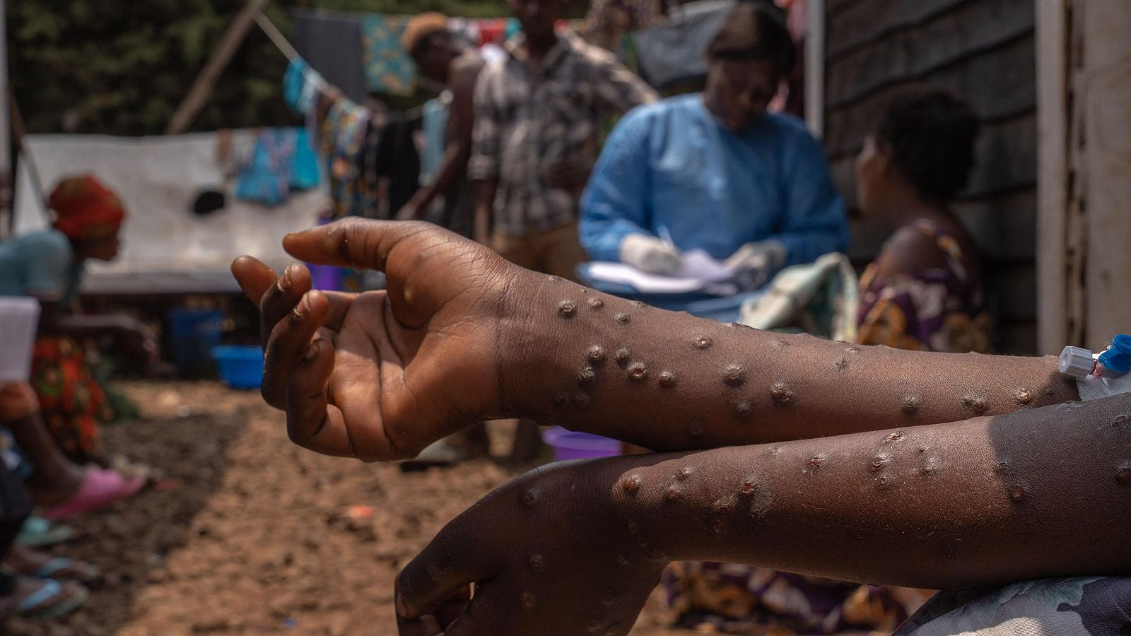 La comunidad médica internacional reitera que África necesita ayuda contra la mpox