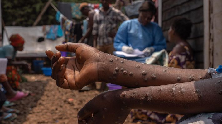 Telediario Fin de Semana - La comunidad médica internacional reitera que África necesita ayuda para frenar el avance de la mpox