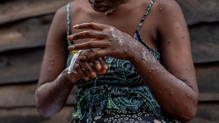 Telediario Fin de Semana - La mpox se extiende por la República Democrática del Congo