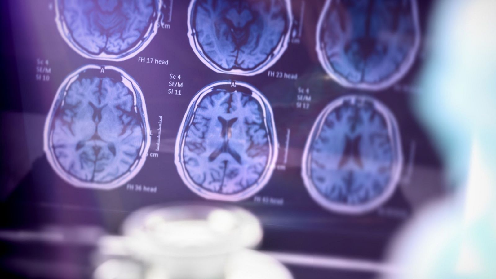 Alzheimer, 1ª causa de demencia neurodefenerativa en el mundo | Ver
