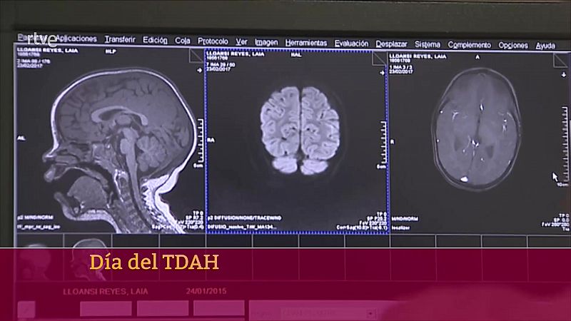 Da del TDAH | Ver