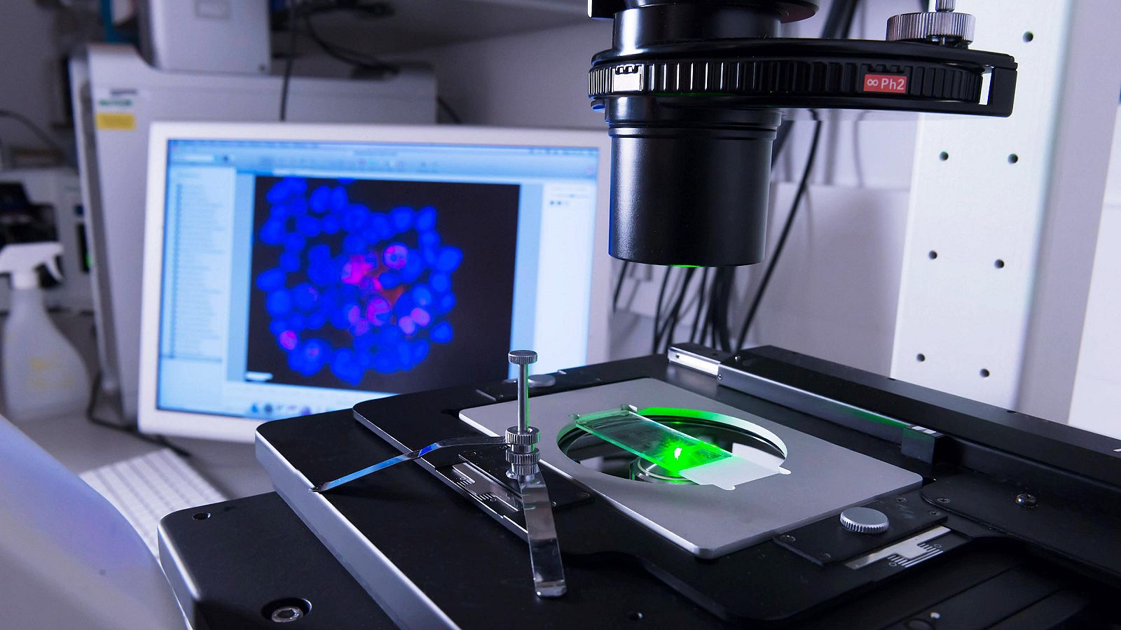 Dos prometedores avances para frenar el cáncer de páncreas