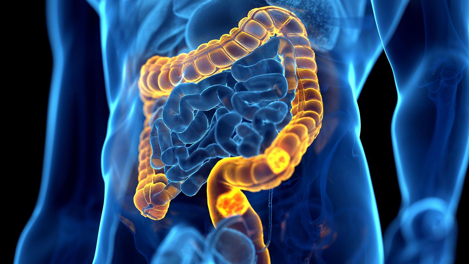 Un estudio relaciona el aumento del cáncer colorrectal en jóvenes con una infección en la infancia