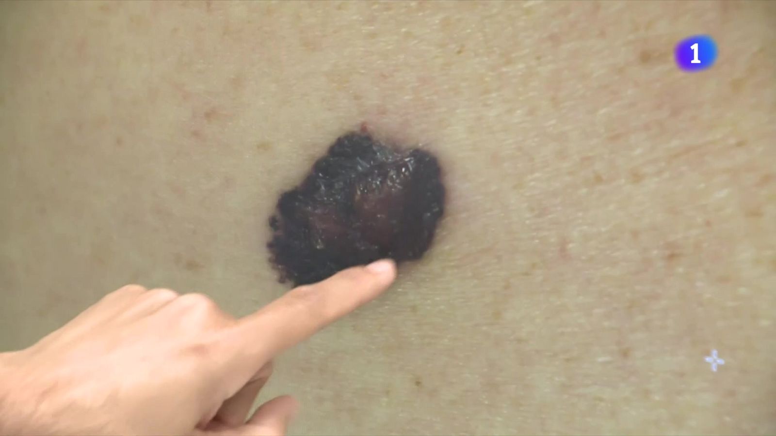 Dia Mundial del Melanoma: alerta sobre el càncer de pell - L'Informatiu | Veure