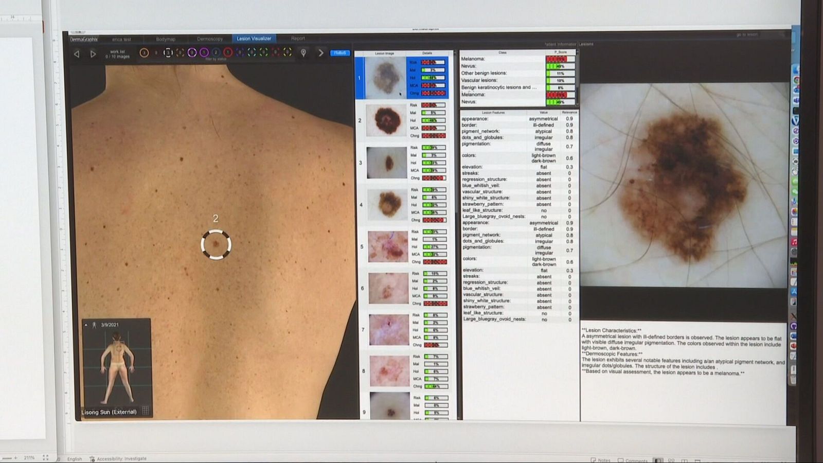 Melanoma: més incidència en majors de 50 anys