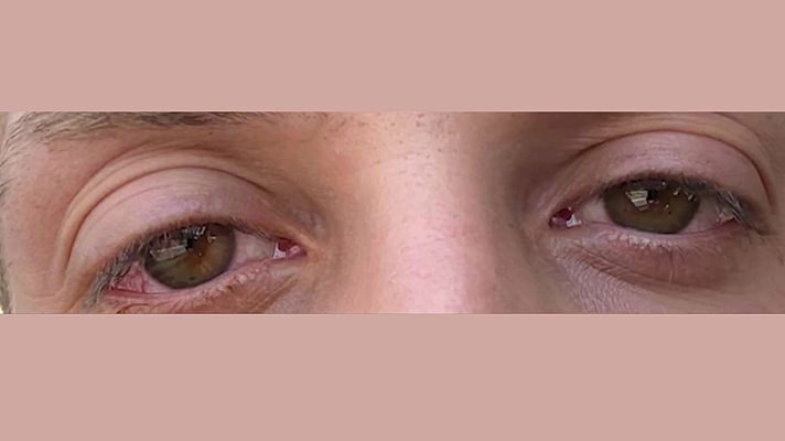 Mañaneros 360 - Lesiones oculares tras ir a la feria