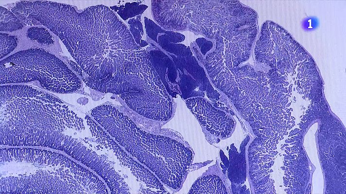 L'Informatiu - Unitat pionera a Vall d’Hebron