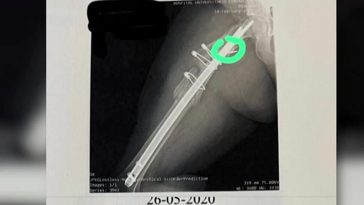 Mañaneros 360 - Se olvidan una broca en mi pierna