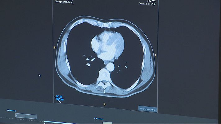 L'Informatiu - Una tècnica pionera millora la supervivència dels pacients amb càncer de pulmó