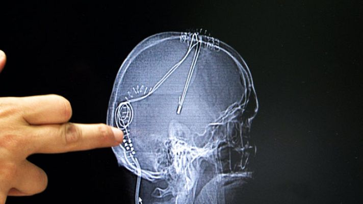 Comando Actualidad - Operación de electrodos