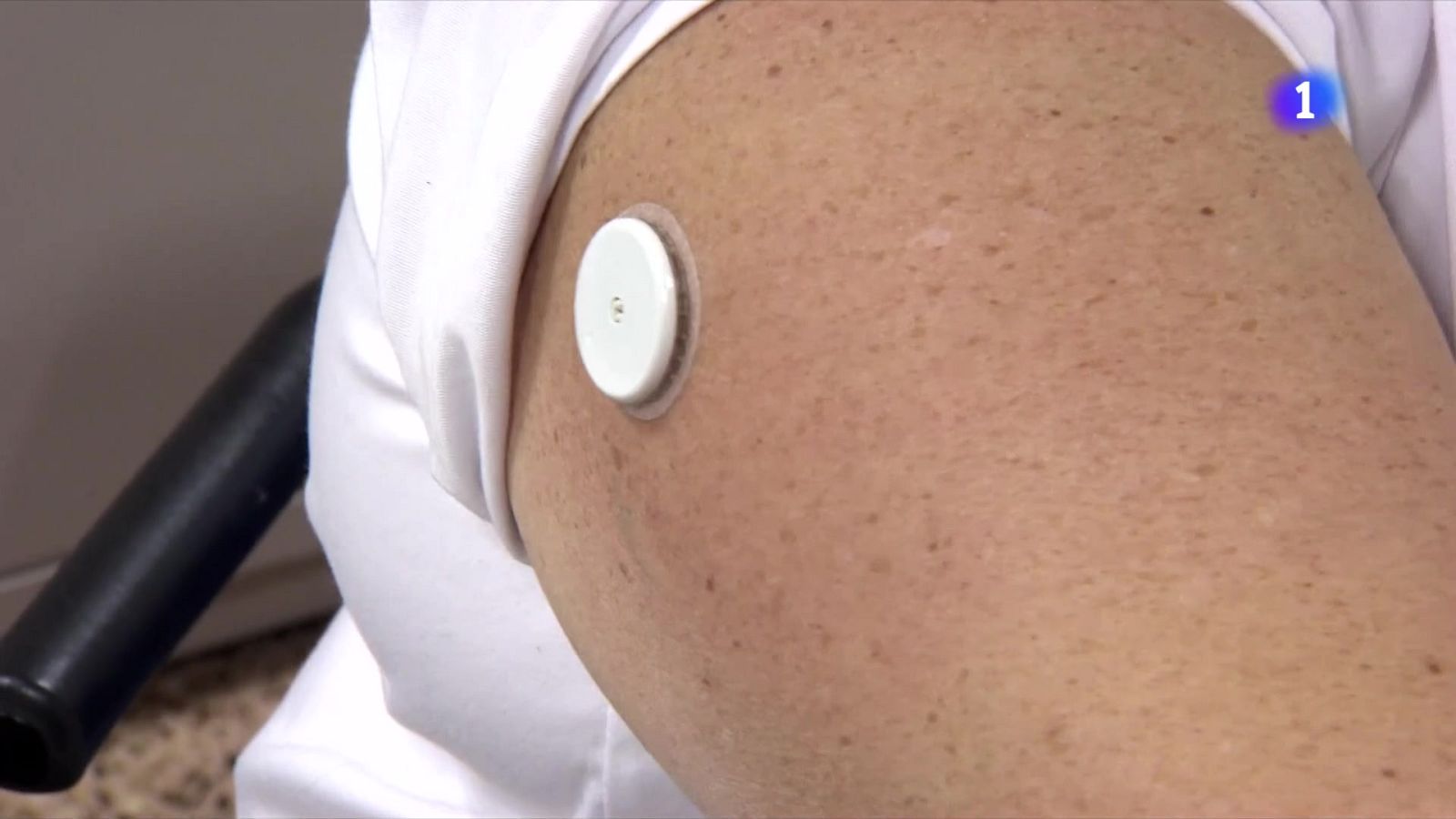 El peu diabètic, una complicació greu que afecta el 20% dels pacients amb diabetis