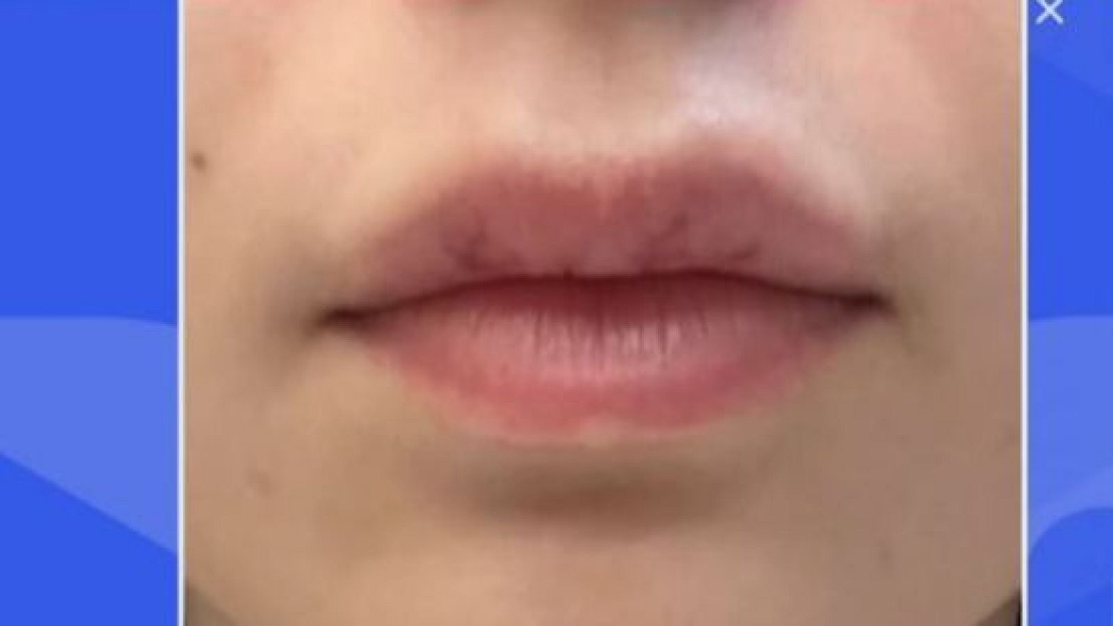 Aumentos de labios con ácido hialurónico sin licencia e ilegal - Directo al grano | Ver