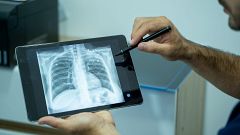 Aumentan los casos de tuberculosis en España un 8,3%