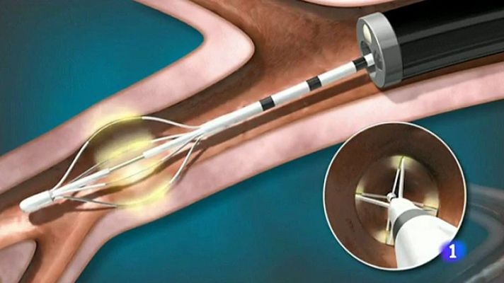 Telediario 1 - Tratamiento contra el asma grave