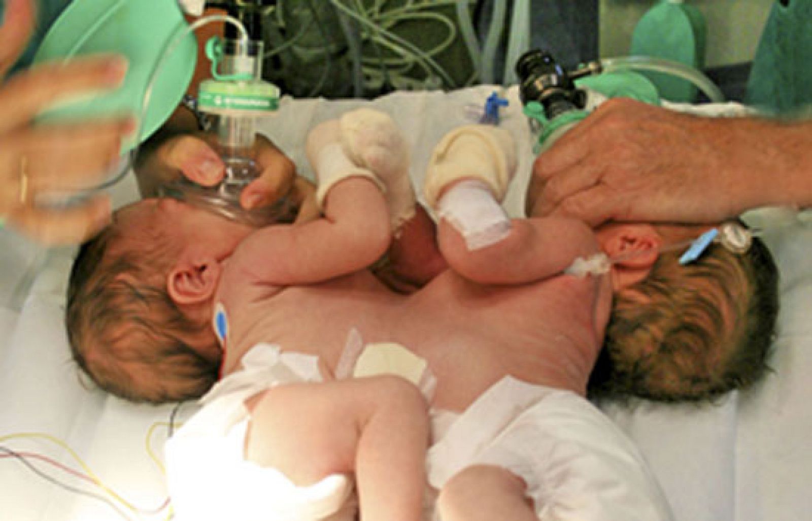 En el Hospital Virgen del Rocío de Sevilla han separado con éxito a unas siamesas que nacieron hace 3 semanas unidas por el abdomen. Después de más de ocho horas de intervención, las pequeñas tienen una vida independiente.