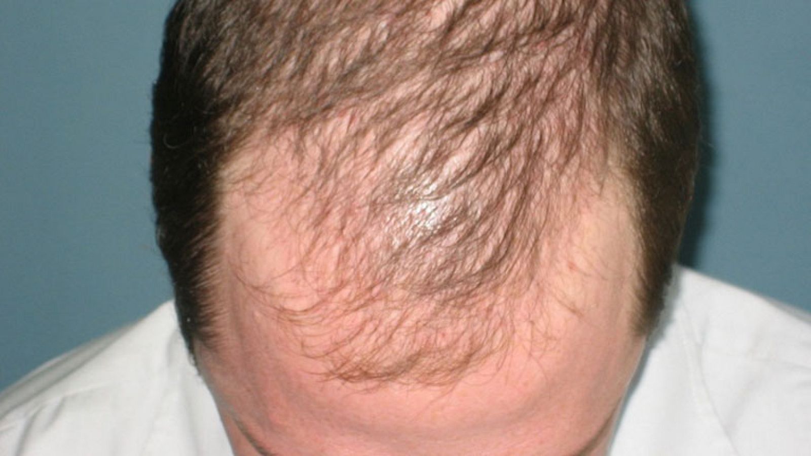 Investigadores estadounidenses logran un método para hacer crecer nuevas raíces del cabello