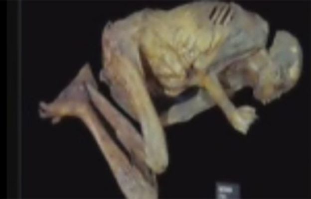 Ciencia y tecnología en Rtve.es - Ya sufrían úlceras en la Antiguedad