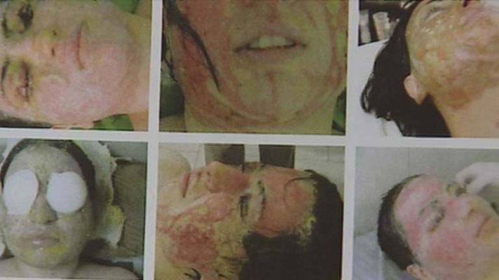 Telediario 1 - Ataques con ácido a mujeres