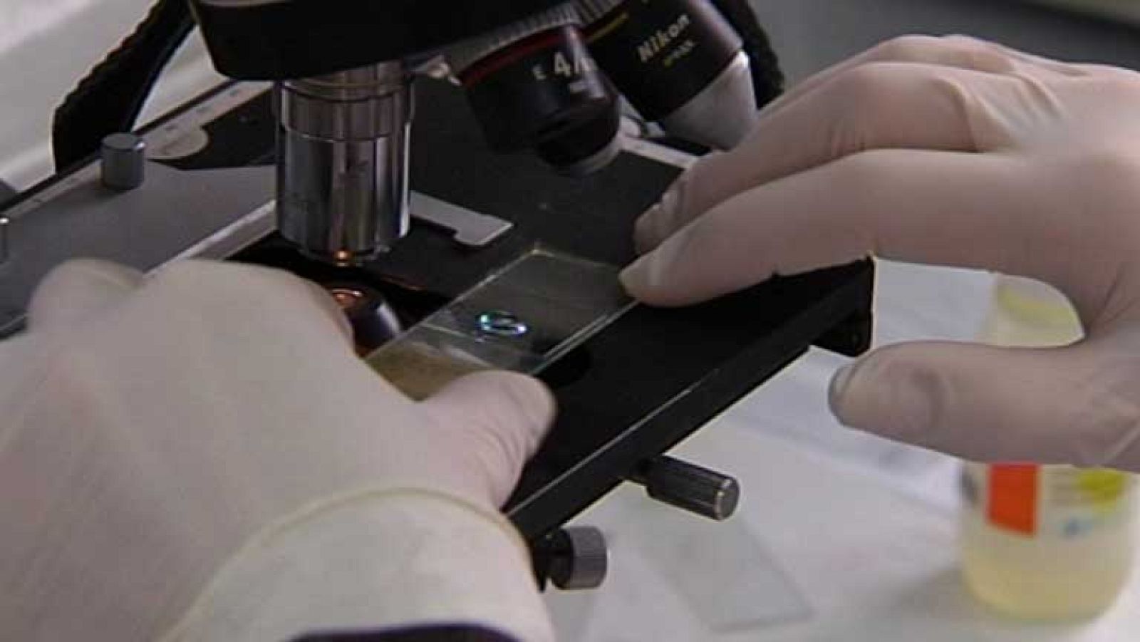 La lepra aún existe en España