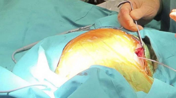 Telediario 1 - Trasplantes de corazón