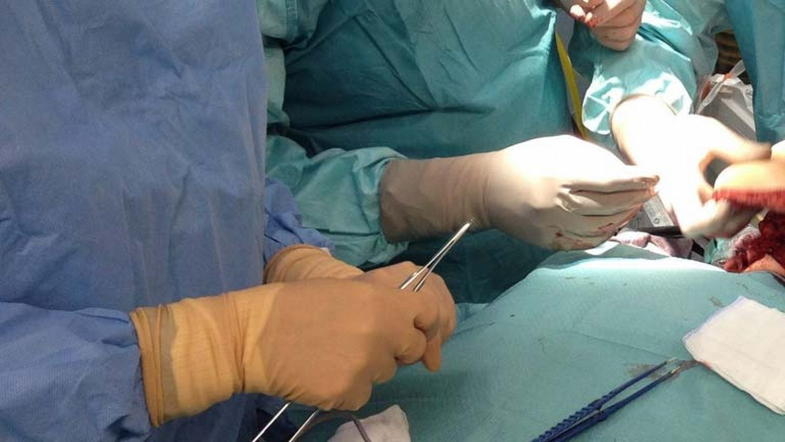 En el hospital de La Paz, se lleva a cabo el segundo trasplante de brazos por encima del codo en España