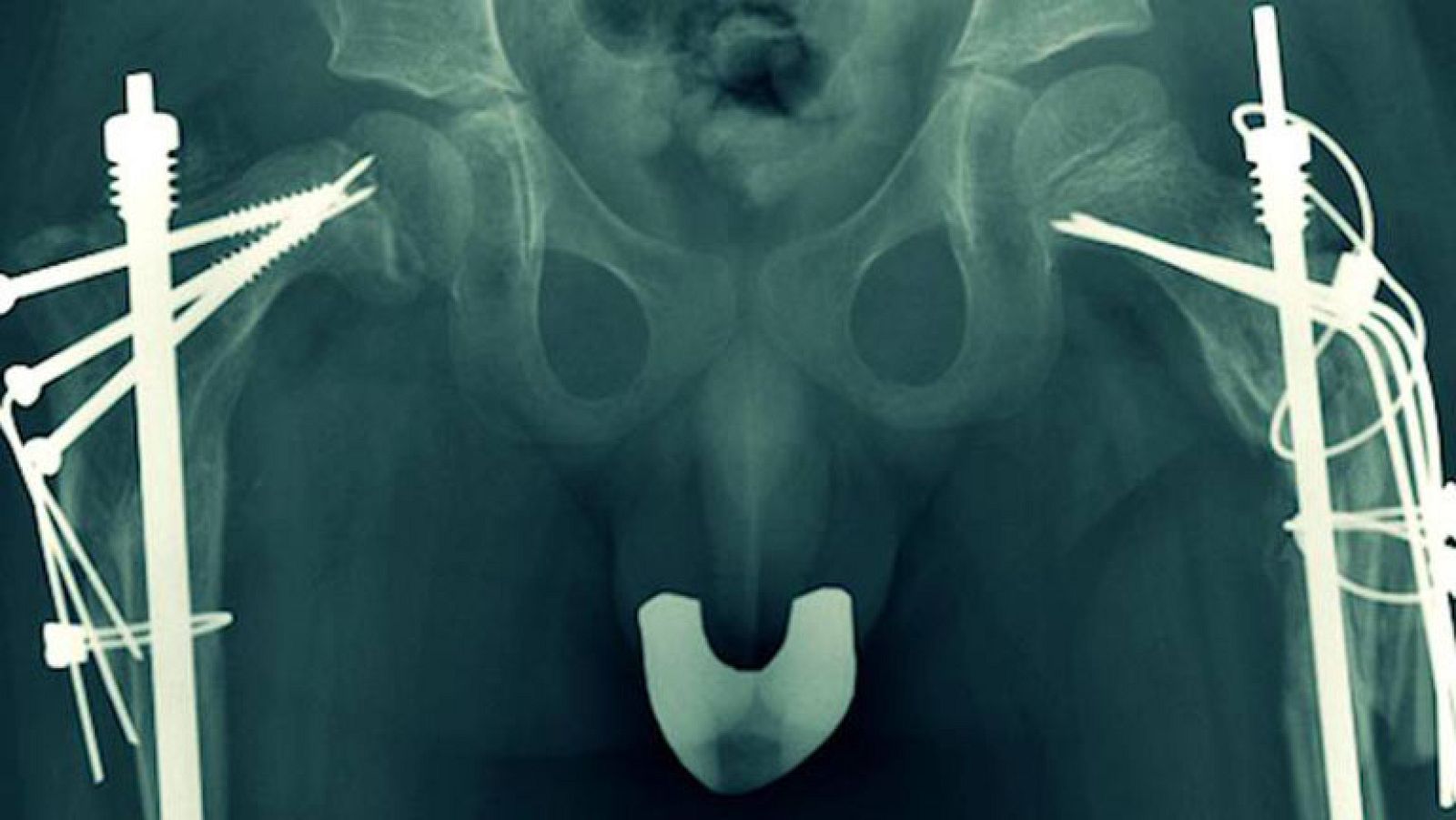 Documentos TV - Avance: 'Frágil. Un camino de cristal'