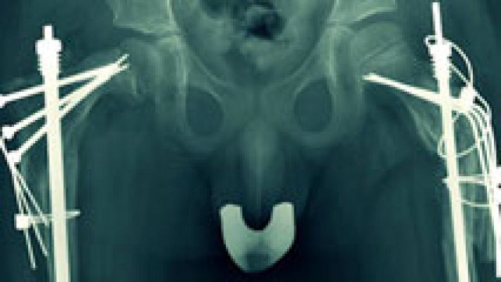 Documentos TV - Documentos TV - Avance: 'Frágil. Un camino de cristal'