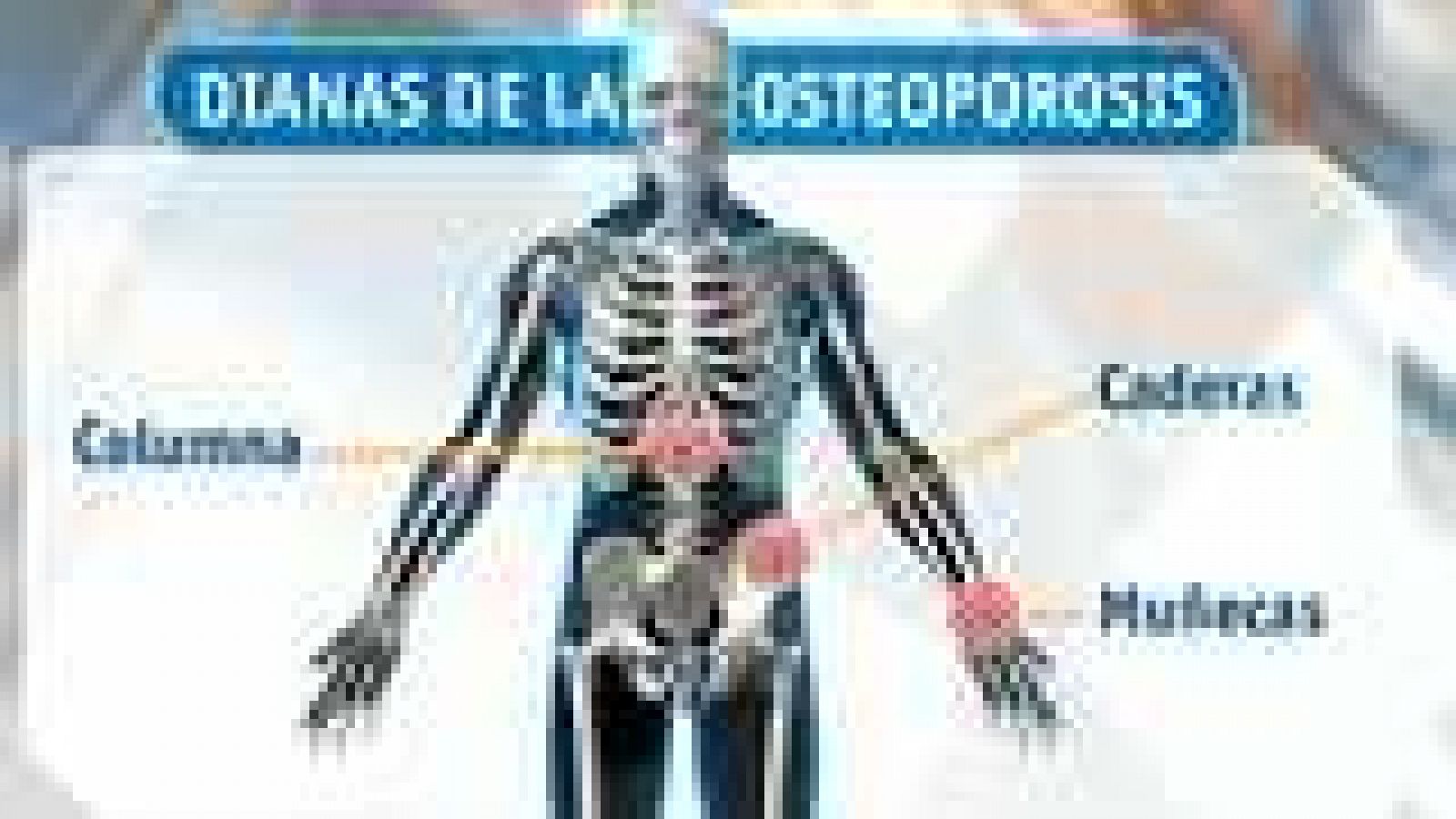 La mañana: Osteoporosis: prevenir la fractura | RTVE Play