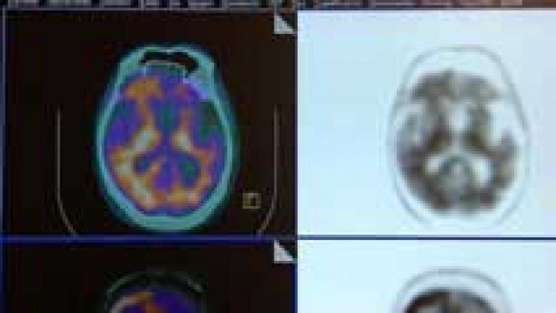 400 expertos buscan un diagnóstico precoz para el Alzheimer