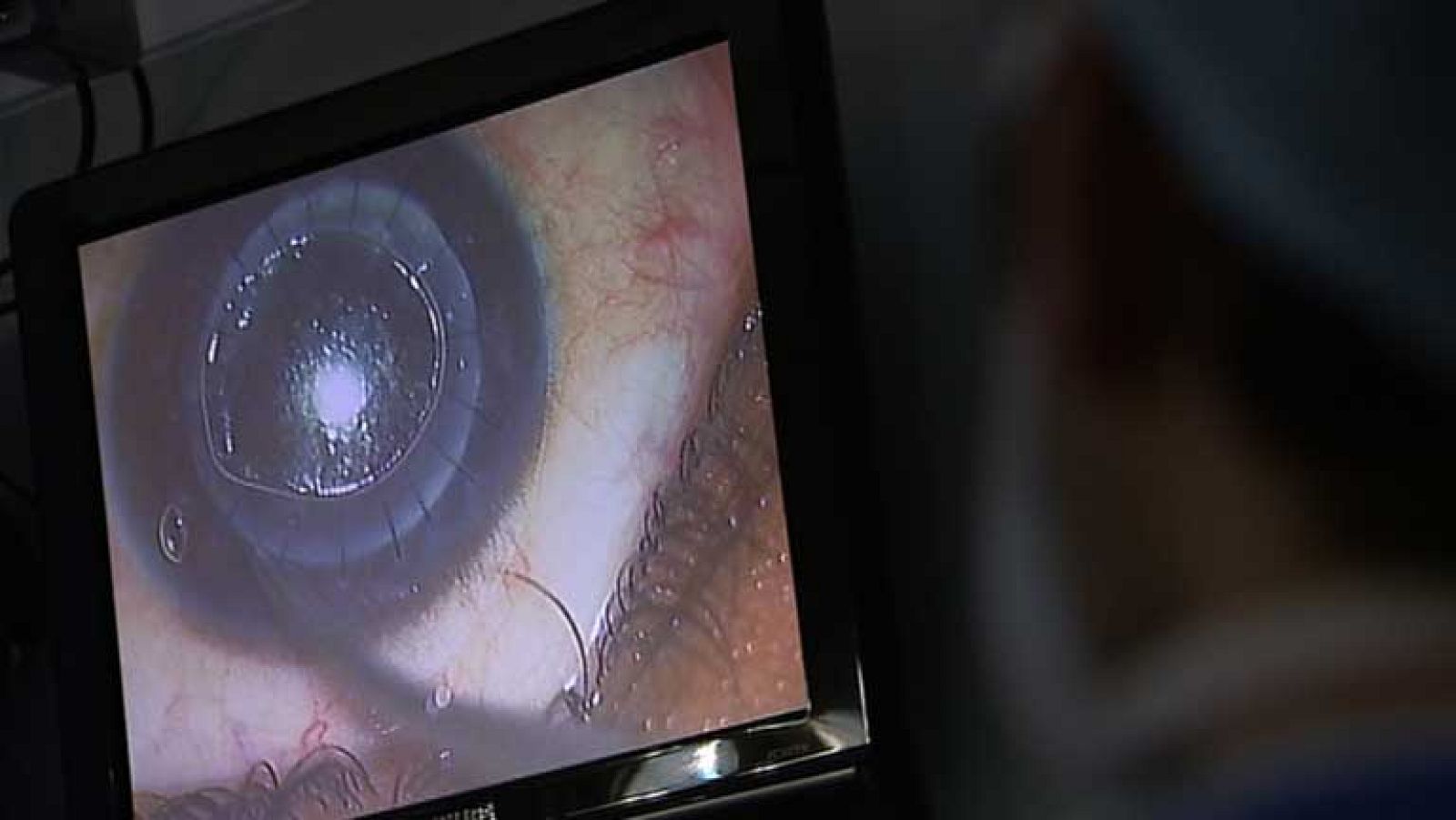 Los trasplantes de córnea se han duplicado en España en los últimos veinte años