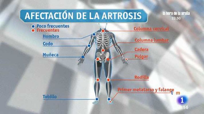 La mañana - Consulta de artrosis