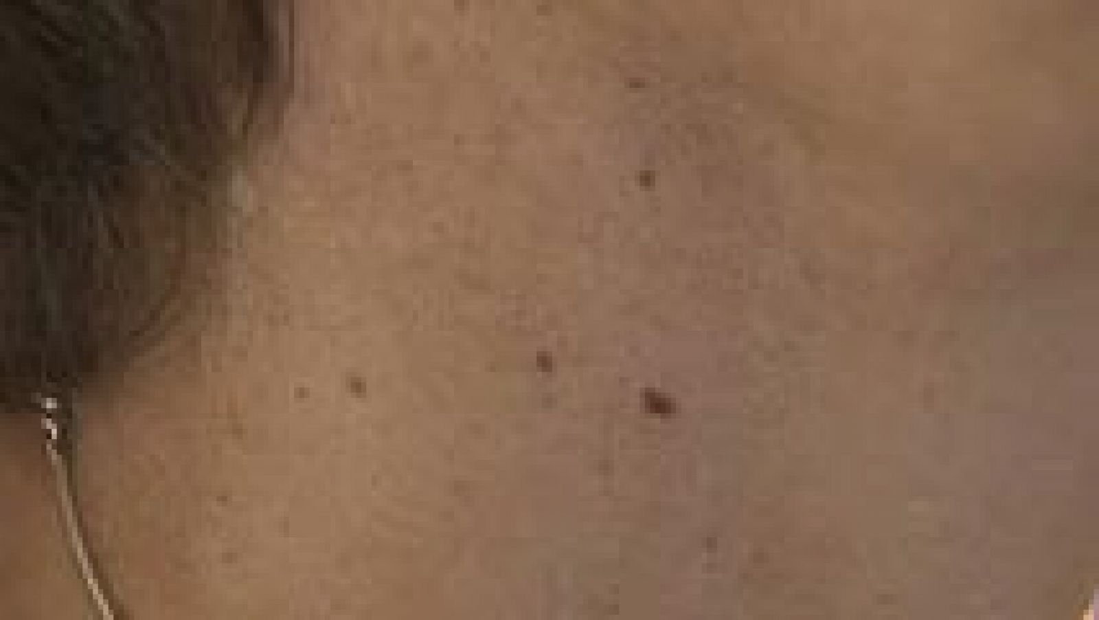 El Centro Nacional de Investigaciones Oncológicas descubre más de 40 genes del melanoma