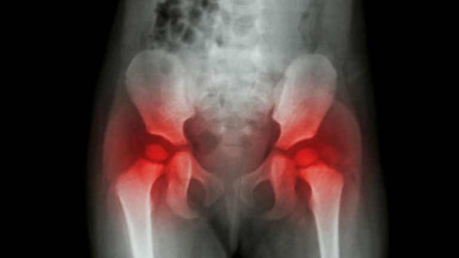 Saber Vivir - Rodilla y cadera