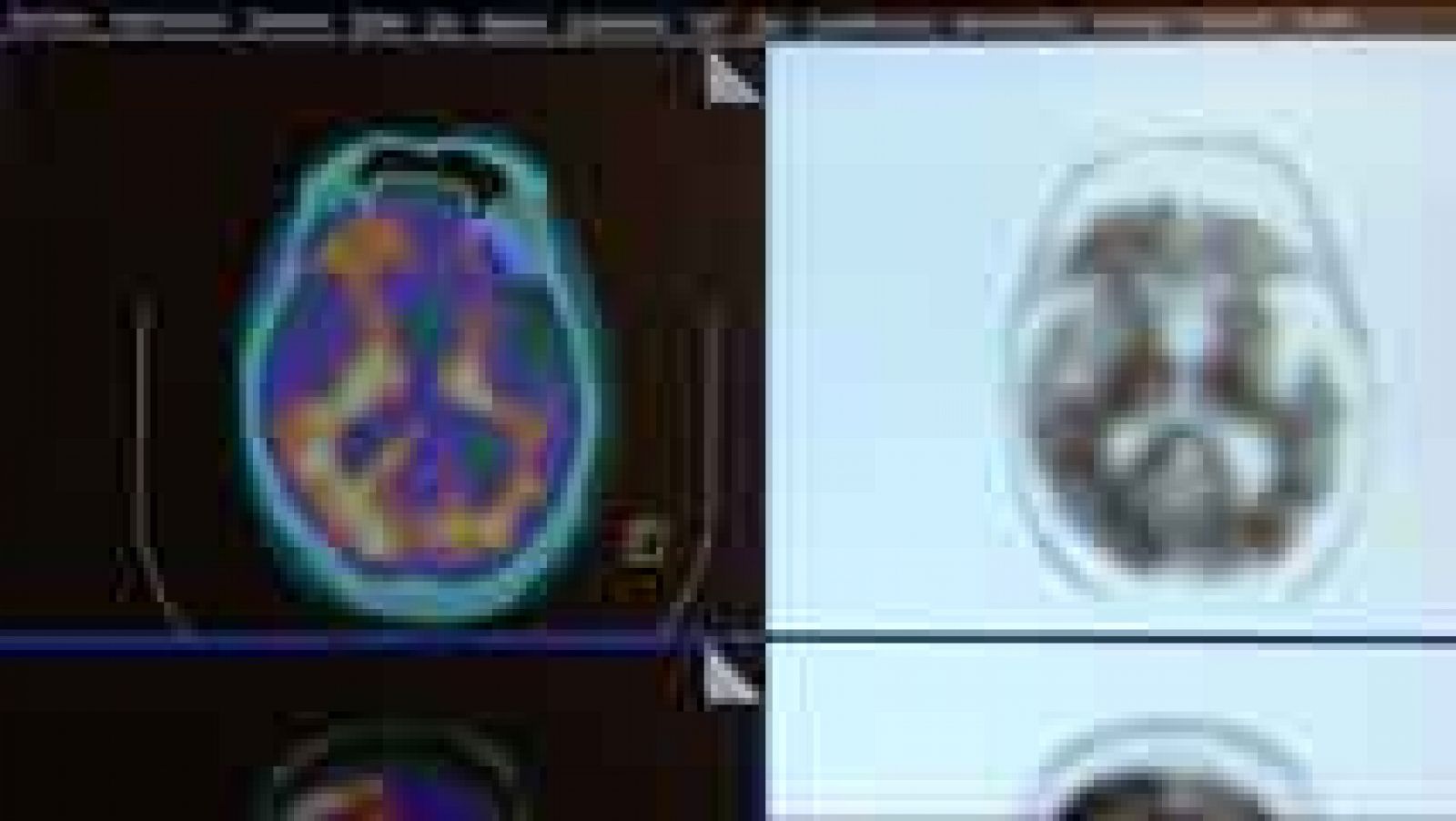 Telediario 1: Los casos de Alzheimer aparecen cada vez más temprano | RTVE Play