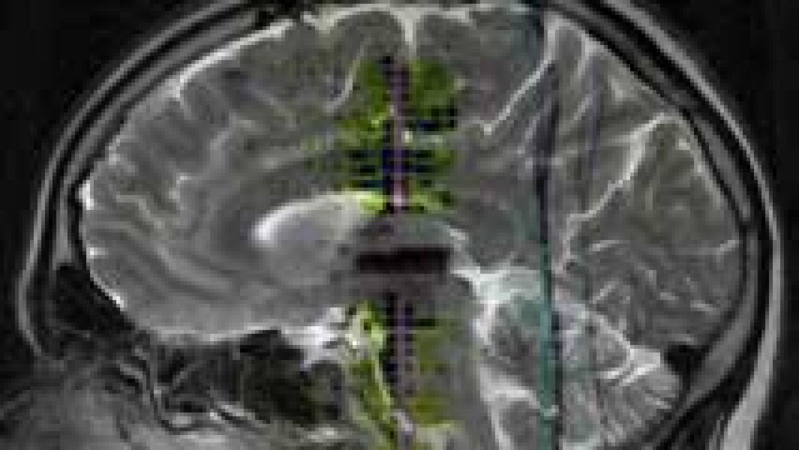 La migraña es la cuarta enfermedad que causa más discapacidad