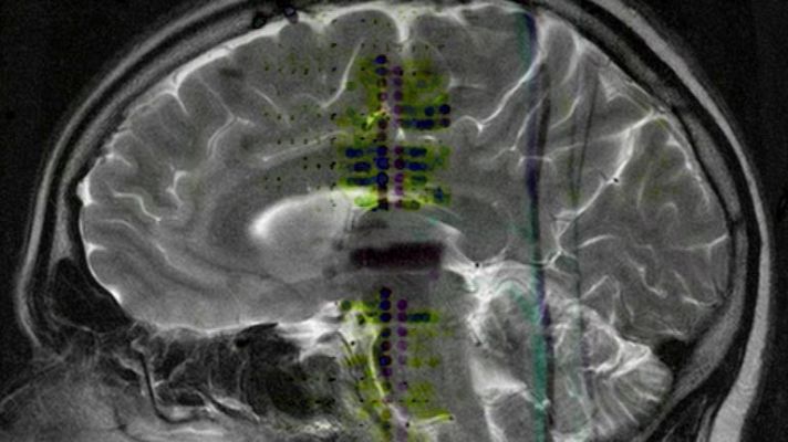 Telediario 1 - La migraña, cuarta enfermedad que causa más discapacidad