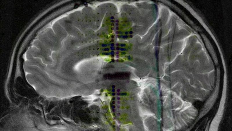 La migraña es la cuarta enfermedad que causa más discapacidad