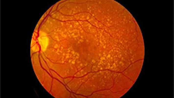Un trasplante de células madre logra regenerar la visión en pacientes con ceguera