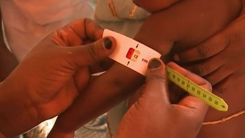 La desnutrición crónica afecta a 52 millones de niños en todo el mundo 