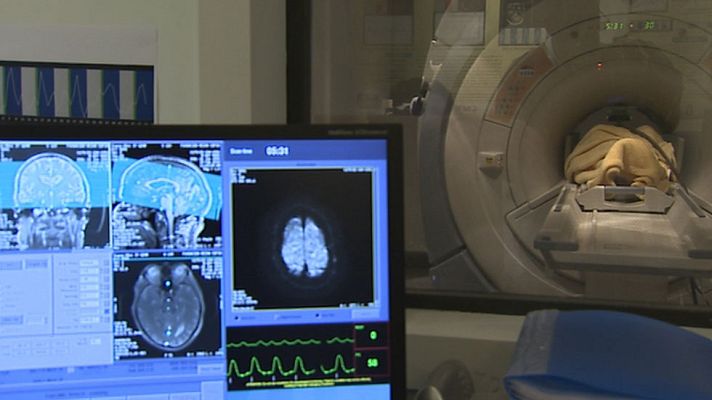 Telediario 1 - Diagnóstico de alzhéimer con un análisis de sangre