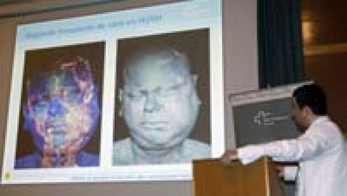 Telediario 1 - Éxito en el segundo trasplante de cara realizado en el Vall d'Hebron